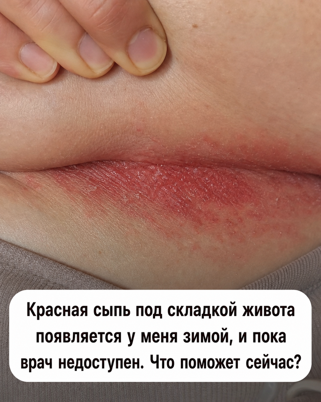 Раздражение в кожных складках зимой: что можно сделать до визита к врачу